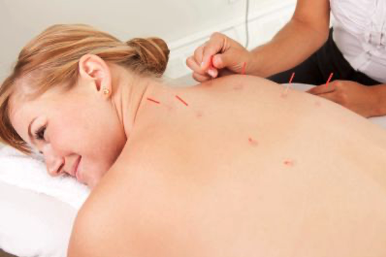 acupuncture