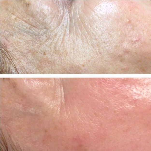 microneedling-2